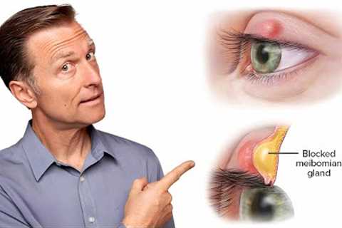 What Really Causes Styes and How to Get Rid of Them Fast